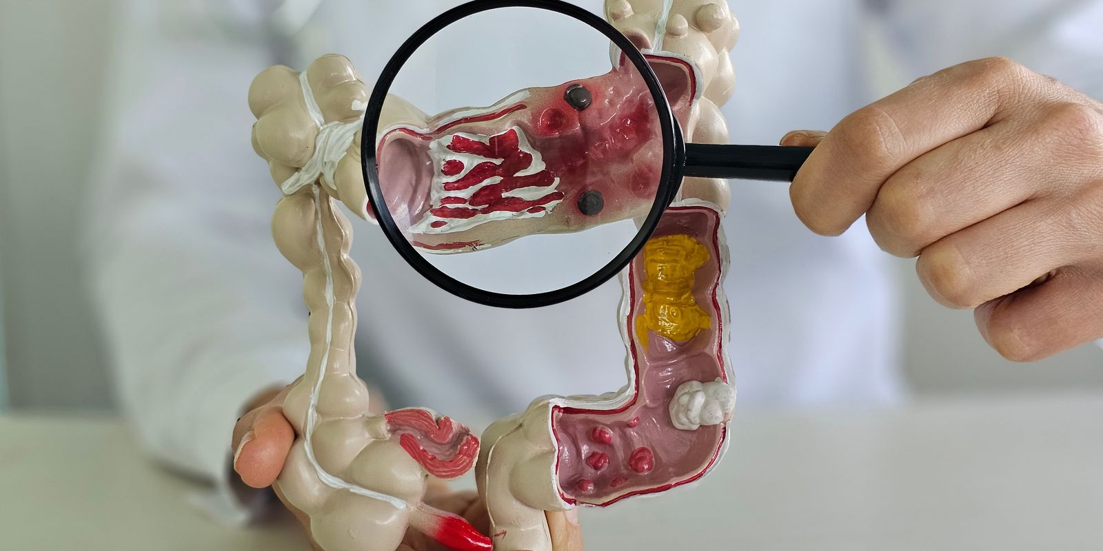 Em 13 anos, doença inflamatória intestinal cresce 5 vezes no Brasil — Imagem: Agencia Brasil